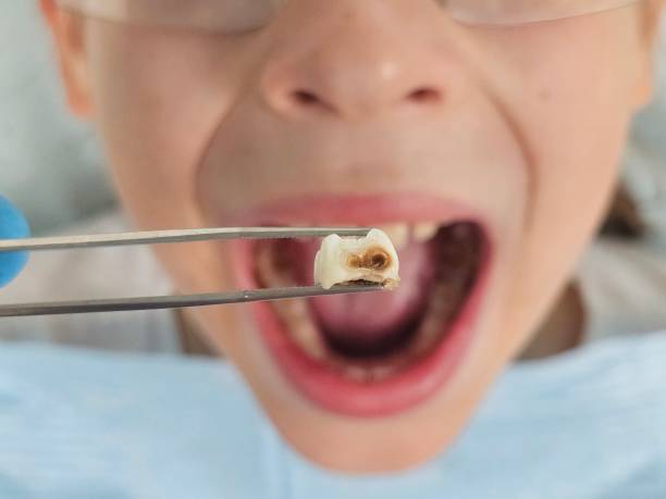 Best Emergency Dentist for Lost Fillings or Crowns in Homer, IL